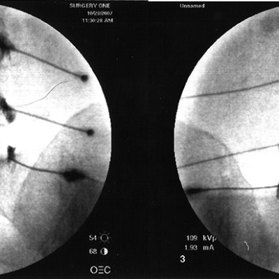 back-needles-1